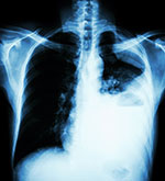 X-ray of a person's chest with lung cancer