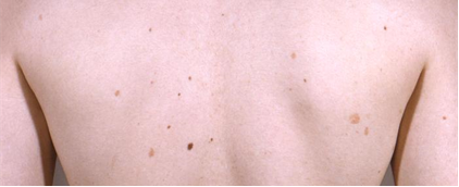 A patient whose back has numerous cutaneous arsenical keratoses following chronic arsenic exposure